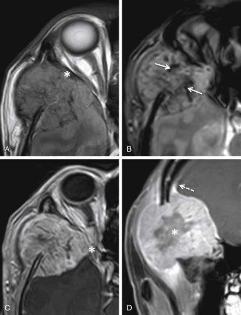 The Sphenoid Bone | Radiology Key