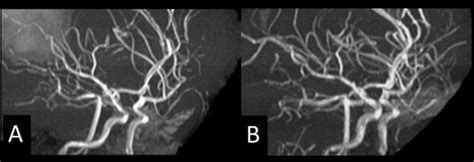 Reversible Cerebral Vasoconstriction Syndrome Associated With Brain Parenchymal Hemorrhage