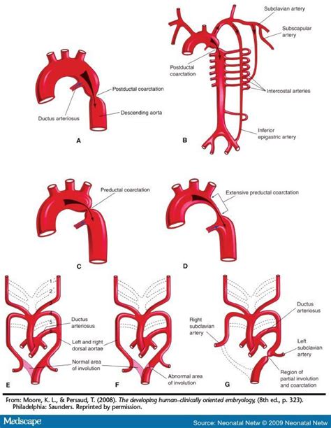 Aortic coarctation