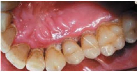 Gingivitis Ulcerativa Necrotizante