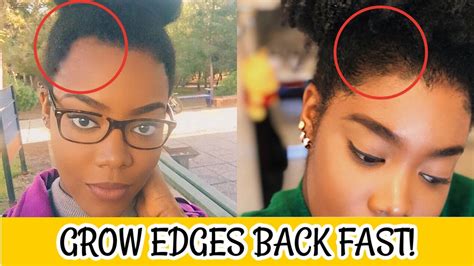 How To Grow Edges Back Fast Best Tips To Regrow C Edges Bald Spots