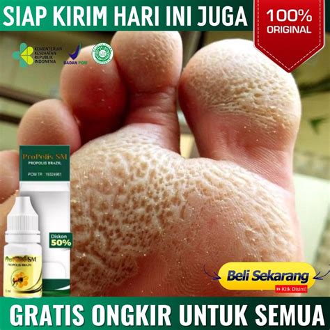 Jual Obat Kaki Rayapan Kaki Bolong Bolong Pitted Keratolysis Mata