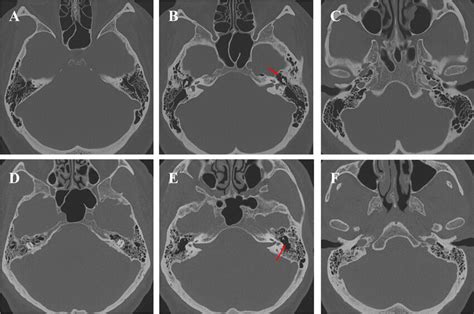 Petrous bone pneumatization. Axial CT scan showing two different highly ...