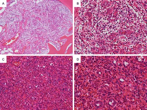 A B Within The Tumor A Slightly Hypocellular Area A Composed Of