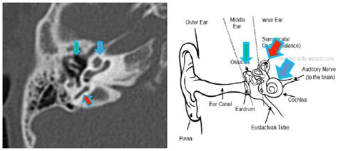 Imaging For Children With Sensorineural Hearing Loss Cincinnati