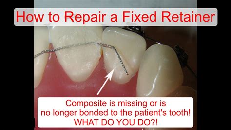 How To Repair A Fixed Retainer YouTube