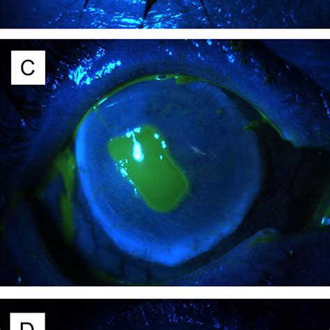 Epithelialization Of A Corneoscleral Tectonic Graft Case 6 After