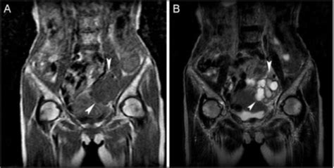 Coronal Magnetic Resonance Imaging MRI Of The Pelvis Open I