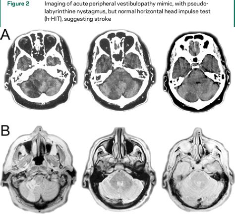 Figure 2 From Normal Head Impulse Test Differentiates Acute Cerebellar Strokes From Vestibular