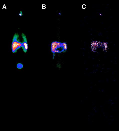 Early Tissue Distribution Of Bone Marrow Mononuclear Cells After Intra