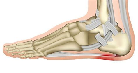 Heel Pain: Christopher Suykerbuyk, DPM: Podiatrist