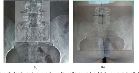 Figure From The Strategy And Early Clinical Outcome Of Percutaneous