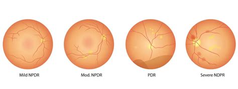 Diabetic Retinopathy Treatment European Eye Center