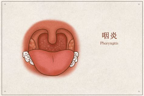 摆脱慢性咽喉炎的困扰，看看专家怎么说？慢性咽喉炎耳鼻咽喉急性咽炎抗生素中医症状穴位治疗疾病 健康界