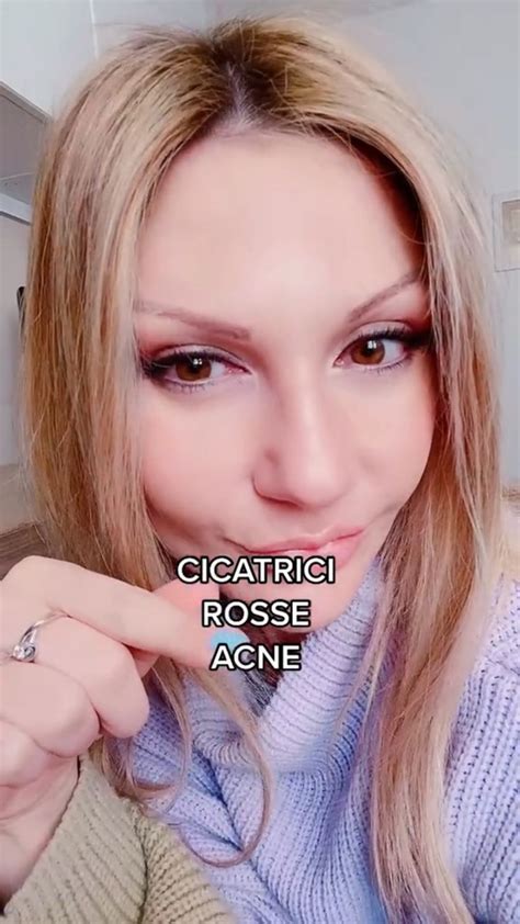 Cicatrici Rosse Acne Acne Consigli Sulla Pelle Consigli Di Bellezza