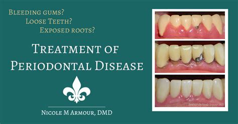 Periodontal Disease Treatment Before And After