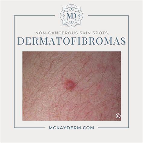 understanding  cancerous skin spots    consult