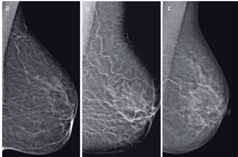 Calcification Of Breast Artery As Detected By Mammography Association