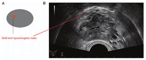 Region Of Interest For Multiparametric Mri Fusion With Transrectal Download Scientific Diagram