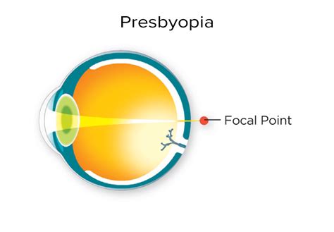 Presbyopia Treatments After 40 Iris Ophthalmology Clinic