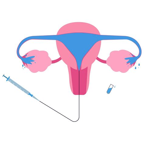 Hysterosalpingogram Or Hsg X Ray Procedure Used To See Fallopian Tubes