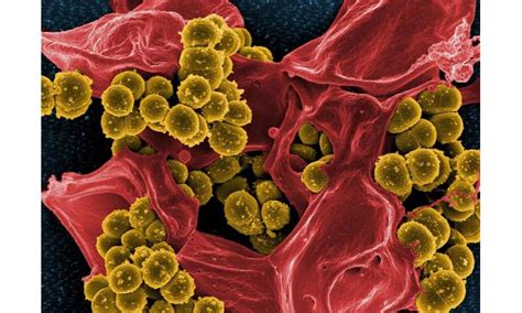 Staphylococcus Aureus Staph Infection