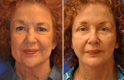 Facelift Austin Tx Dr Weinfeld