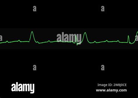 Ecg Shows Complete Av Block 3rd Degree Av Block Of The Heart Stock