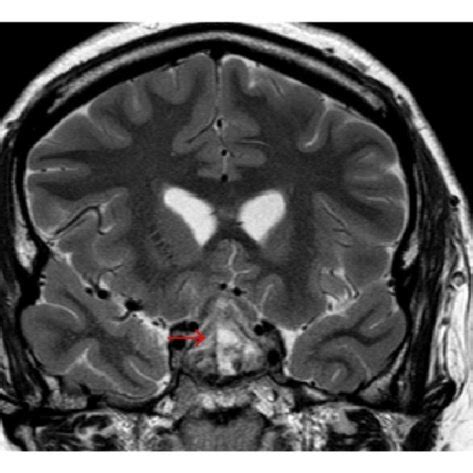 Prolactin stain of pituitary mass confirms prolactinoma. | Download Scientific Diagram