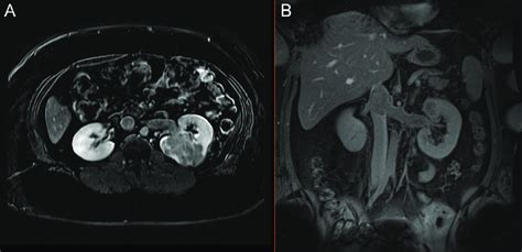 Dynamic Contrast Enhanced Mri In A Year Old Woman With A Large