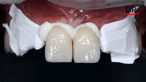 Your Go To Guide For Cementation Of All Types Of Prosthesis Part 1