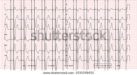 Ecg Example Dual Chamber Pacemaker12lead Rhythm Stock Illustration