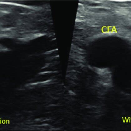 Duplex Ultrasound Showing Right Saphenofemoral Junction With Thrombus