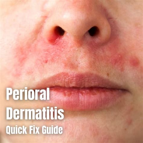 Weleda Products For Perioral Dermatitis Outlet Dakora Co