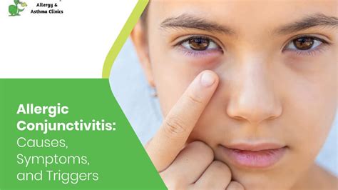 Allergic Conjunctivitis Causes Symptoms And Triggers