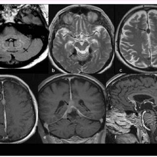 MRI of the brain, acquired 3 years later; axial T2-weighted image shows ...