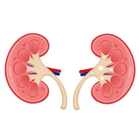 Urologia Goi Nia Ver O Acende Alerta Para C Lculos Renais