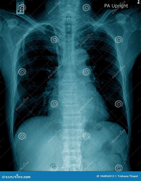 Image De Radiographie Pulmonaire Dans Le Ton Bleu Photo Stock Image