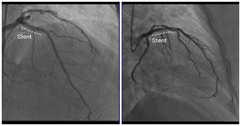 Case 7: Proximal LAD stent underexpansion and malapposition ...