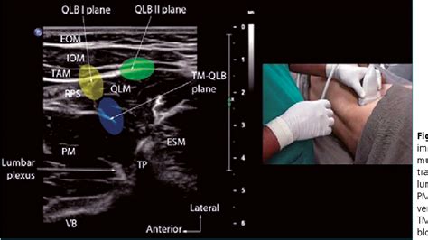 Figure 1 From Analgesic Efficacy Of Erector Spine Plane Versus