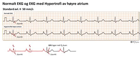 Index Of Elaring Fag Hjertesykdommer Spl Ekg Del Images