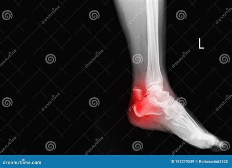 Radiografia Do Raio Do Tornozelo Mostrando Calcaneus De Fratura