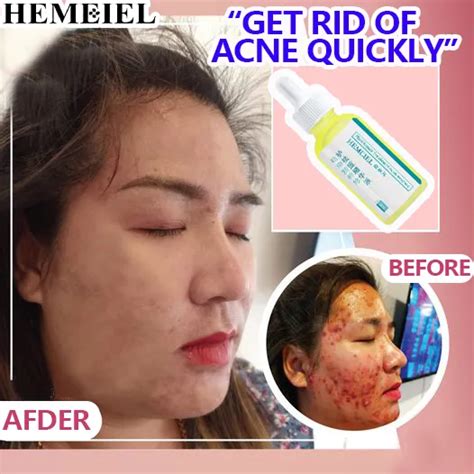 HEMEIEL Pimple Eraser Quick Fx Acne Remover Anti Acne And Pimples