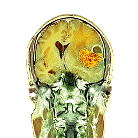 Brain cancer, MRI scan Photograph by Science Photo Library