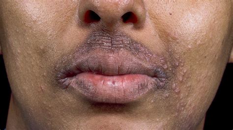 Dyshidrotic Eczema On The Lips | Lipstutorial.org