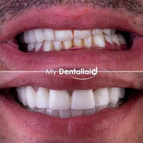 Tooth Crown Before and After - Reviews - Dentallaid