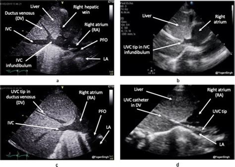 Application Of Cardiac Pocus In Assessment Of Umbilical Venous Download Scientific Diagram