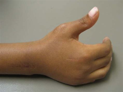 Acquired Trigger Thumb Vs Congenital Clasped Thumb Recognize The