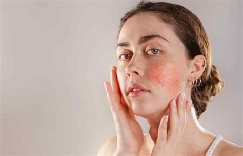 How To Get Rid Of Redness On Your Face Without Makeup Mugeek Vidalondon