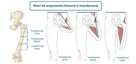 Amputación femoral Qué es causas síntomas tratamiento y consejos